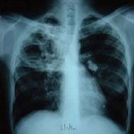 Obezitatea si fumatul duc in egala masura la deces, potrivit unui studiu