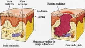 STA-4783  - medicament care obliga celulele canceroase sa se autodistruga