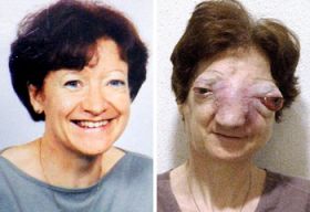 Chantal Sebire, frantuzoaica mutilata de o tumoare faciala a fost gasita moarta in casa