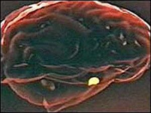 Litiul are efecte benefice asupra pacientilor atinsi de maladiile neuromotorii