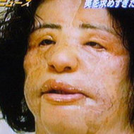 O femeie dependenta de operatii estetice si-a injectat ulei de gatit in fata