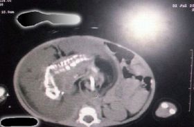 O fetita de un an din Arabia Saudita este insarcinata cu propriul fratior