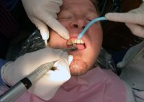 Iasi. Un dentist amator i-a taiat pacientului o bucata de limba, cu freza