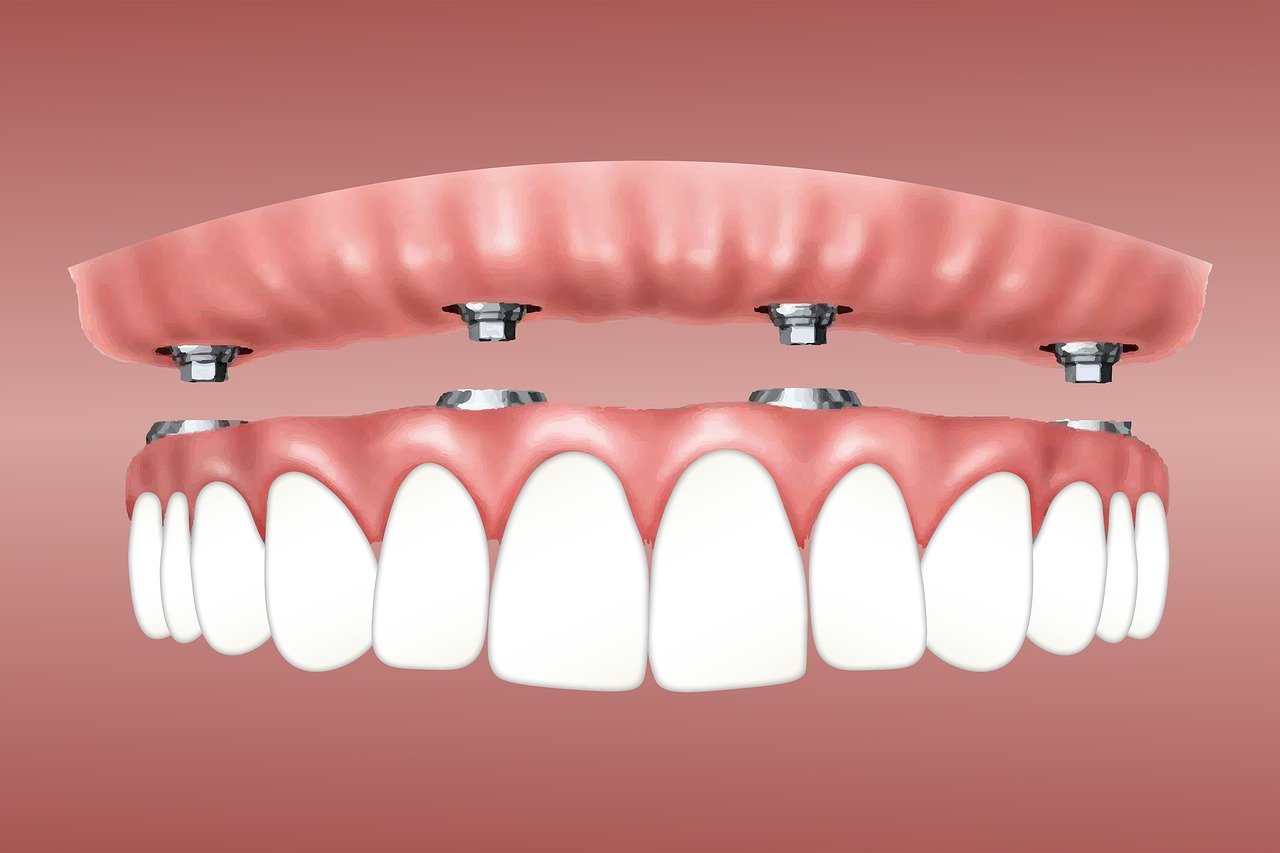 Implanturi-dentare-vs.-fatete-dentare