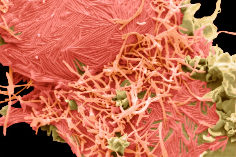 Virusul HMPV din China, confirmat în România. Primul caz de îmbolnăvire s-a înregistrat la o femeie care nu a călătorit în străinătate