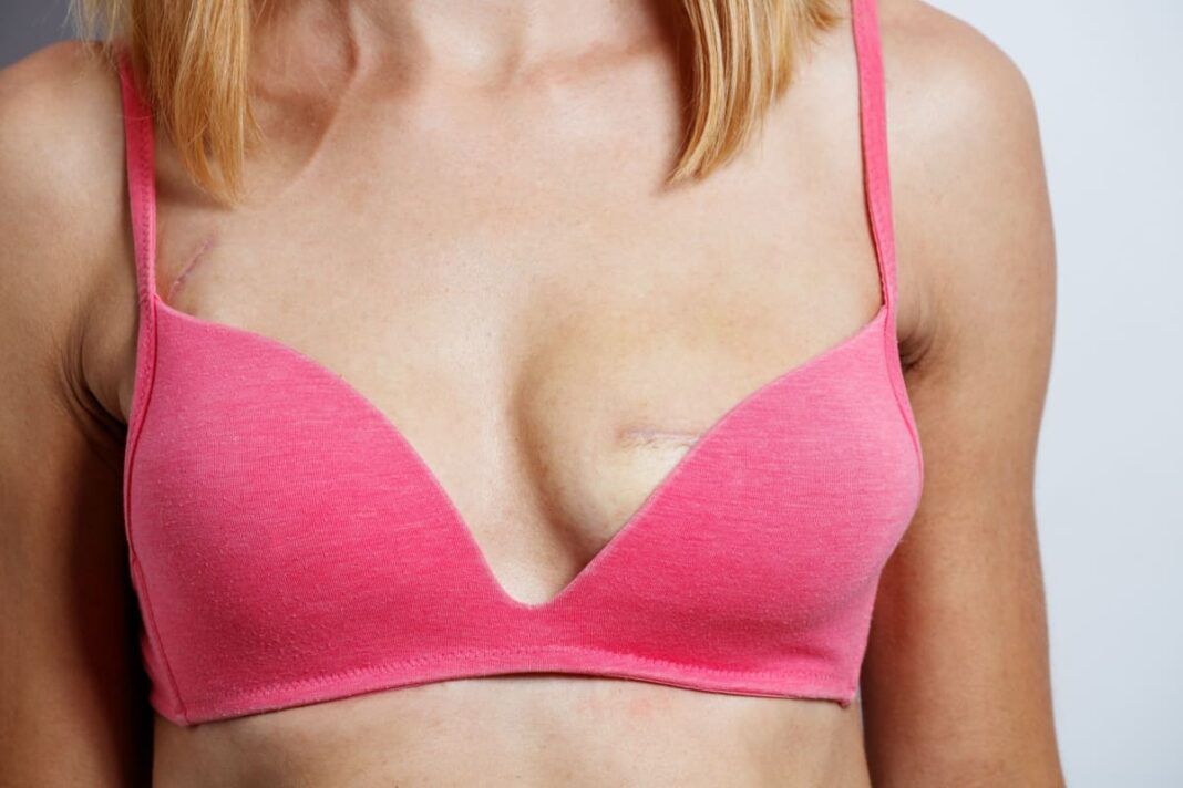 decolteu femeie cu cicatrice pe san (1)